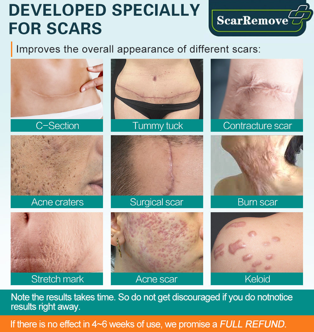 ScarRemove™ Advanced Scar Spray voor alle soorten littekens (1+1 gratis)